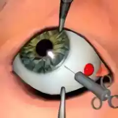 眼科手术官方版